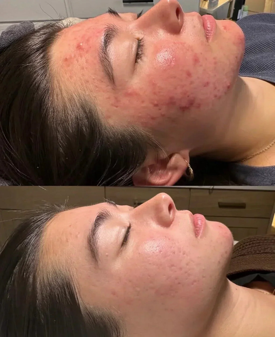 INTRODUCING OUR 12 WEEK VIRTUAL ACNE BOOTCAMP