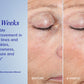 Active Peel System