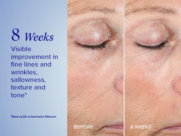 Active Peel System
