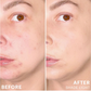 Glo Skin Beauty Spot Treat Concealer is a long-wearing acne concealer with 1% salicylic acid that conceals blemishes while supporting clearer-looking skin at The Skyn Distillery Wayzata MN.