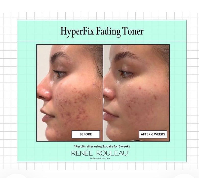 Before and after effect of HyperFix Fading Toner on a person's face, with text indicating results after 6 weeks of use available at wayzata, mn skincare and sauna studio